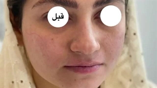 تزریق لب، چانه و کانتورینگ گونه - کلینیک مهزیار