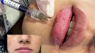 تزریق ژل لب - کلینیک مهزیار