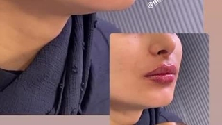 عکس قبل و بعد تزریق ژل لب - کلینیک مهزیار