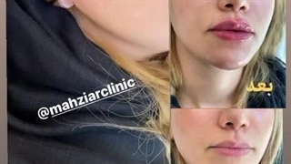 تزریق ژل لب و تزریق چانه - کلینیک مهزیار