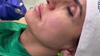 تزریق چانه در کانتورینگ صورت - کلینیک مهزیار