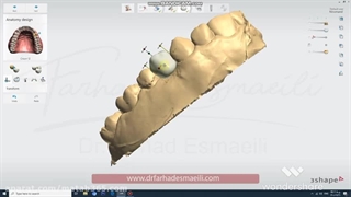 ایمپلنت فوری در اصفهان