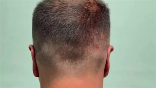 نمونه جراحی اتوپلاستی گوش