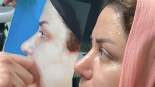 یکماه بعد از عمل بینی