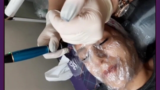 بهترین زمان شستن صورت بعد از میکرونیدلینگ ماموپلاستی
