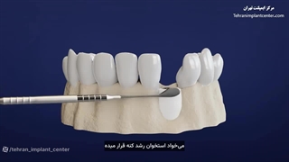 انیمیشن مراحل ایمپلنت دندان با زیرنویس فارسی - مرکز تخصصی ایمپلنت تهران
