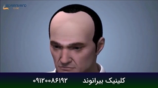 روش FUT در کاشت مو