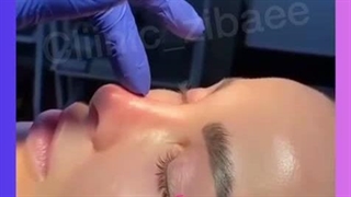 عمل بینی در کلینیک آرتین