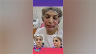 نمونه‌ای از تزریق چربی به صورت تزریق بوتاکس