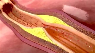 تشخیص حمله قلبی | انیمیشن سه بعدی