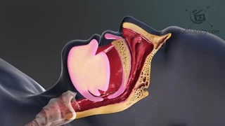 درمان خروپف در انیمیشن پزشکی خواب