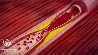 انیمیشن پزشکی آنژیوپلاستی عروق کرونر