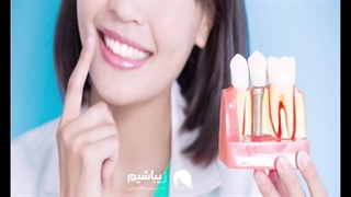 معرفی بهترین متخصص ایمپلنت در تهران