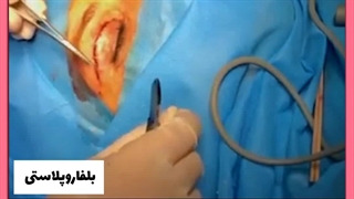 بلفاروپلاستی با بیمه تکمیلی