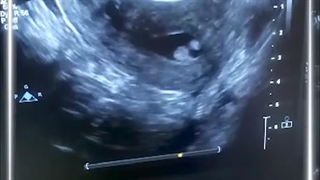 سونوگرافی واژینال ترانسSIS