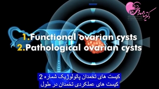 کیست تخمدان