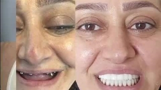 نمونه جراحی ایمپلنت در تهران