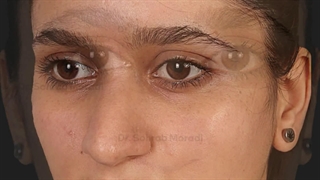 عمل زیبایی بینی