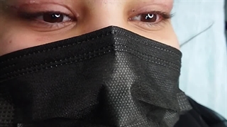 جراحی پلک در کلینیک آرتین