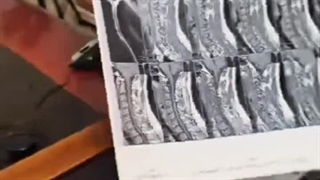 دیسک گردن انتریور