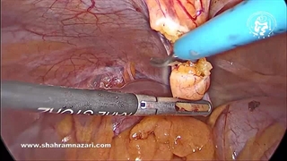 لیپوم‌های طناب کورد و لیگامان گرد در ترمیم هرنی