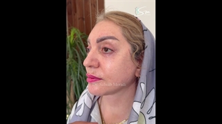 جراحة شد الوجه والرقبة