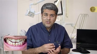 انواع جرم دندان