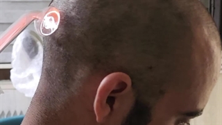 اوزون تراپی در کلینیک آوینا