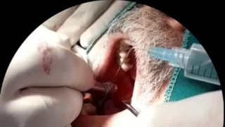 کاشت دندان ایمپلنت آقای صبوری در مطب دکتر پورصادقی