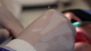 دکتر عباس گشاده رو ایمپلنت میکرونیدلینگ
